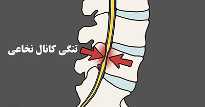 تشک طبی مناسب برای تنگی کانال نخاع